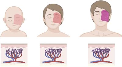 GNAQ mutations drive port wine birthmark-associated Sturge-Weber syndrome: A review of pathobiology, therapies, and current models